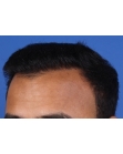 After Hair Transplant&nbsp;Front